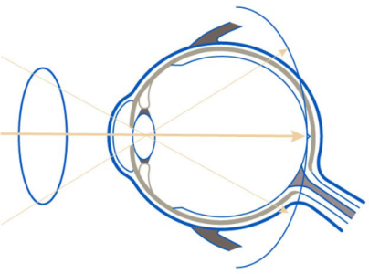 Grafika 1. Schemat korekcji krótkowzroczności tradycyjnymi soczewkami okularowymi, gdzie promienie centralne ogniskują się na siatkówce, a promienie peryferyjne za siatkówką.